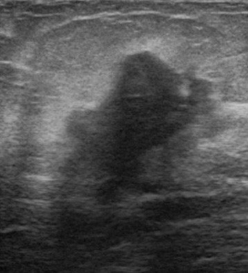 乳癌（浸潤性乳管癌）