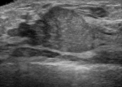 乳癌（粘液癌）