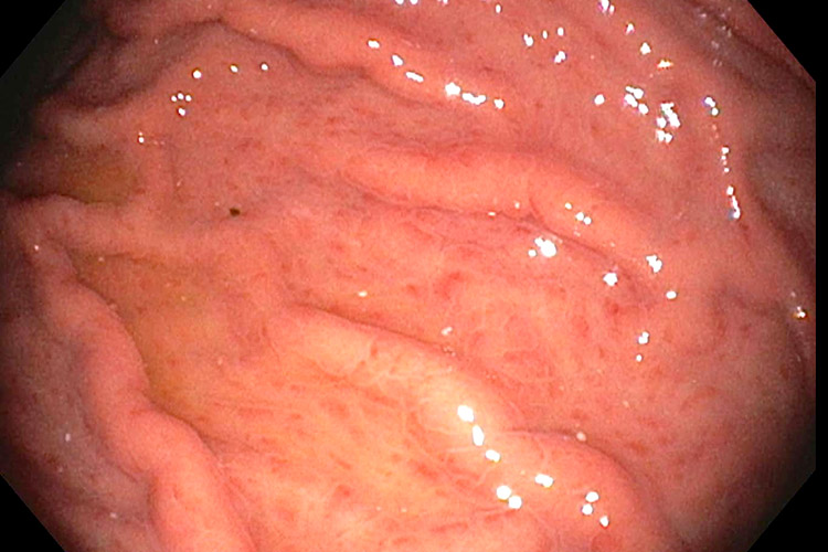 ピロリ菌による慢性胃炎