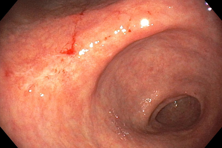 ピロリ菌除菌後の早期胃癌